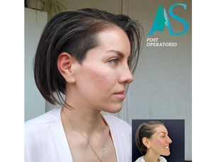 ✨Promoción especial.  Rinoplastia ultrasónica estética y/o funcional