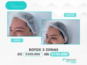 Promoción - Bótox 3 zonas ahora por $ 195.000