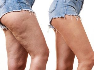 Anticelulitis, tu piel más Lisa más Firme, más Tú. (glow corporal)
