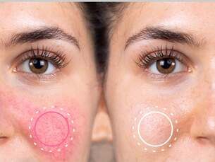 Rosácea 8 sesiones de láser + diagnóstico y rutina de skincare