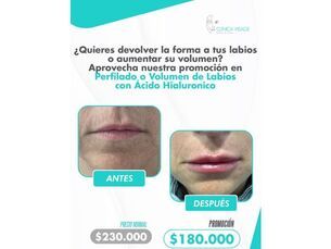 👄 Luce unos labios irresistibles aumento o perfilado de labios!
