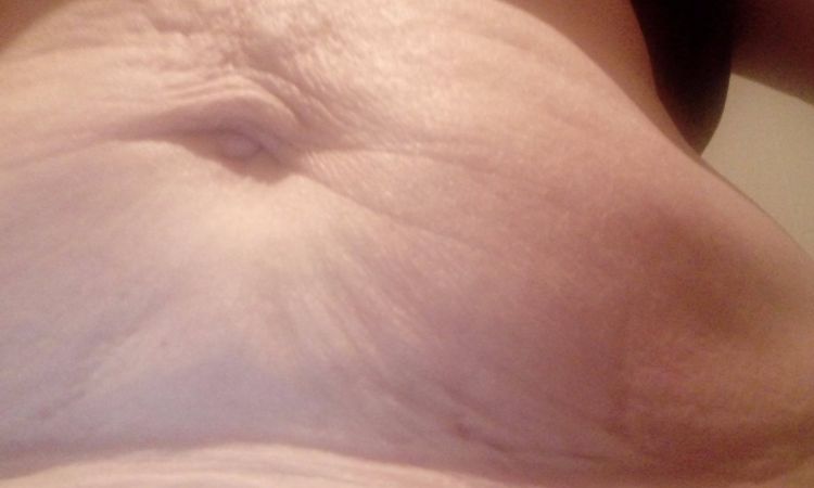 Fonasa cubre operacion abdominoplastia - 1983