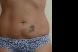 Valor Hilos Tensores Abdomen bajo