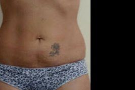 Valor Hilos Tensores Abdomen bajo - 3784