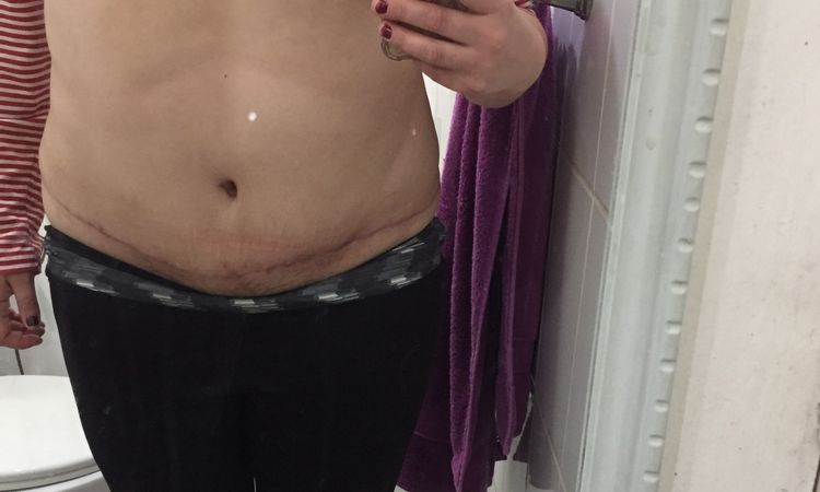 Triste por mi evolución abdominoplastia - 5600