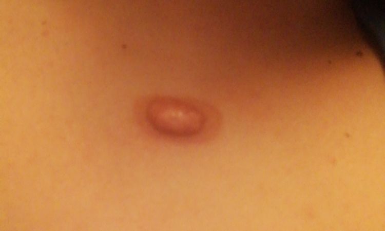 Tengo un queloide que ya me duele y me pica quiero sacarmelo - 6489