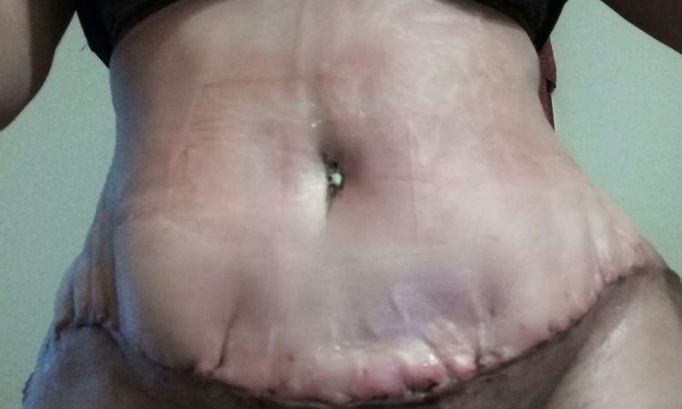 Mi sutura de abdominoplastia no está lisa se ve fea como mal cocida . - 7245