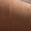 Borrar cicatriz de autolesiones