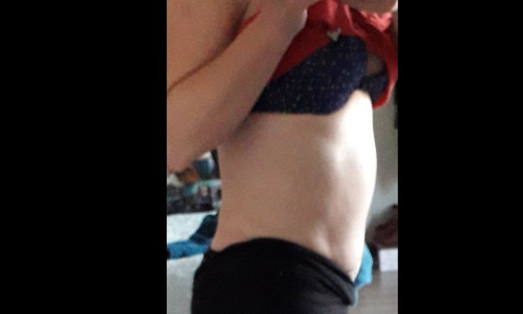 Abdomen alto abultado después de abdominoplastia - 7482