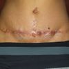 Abdominoplastia mal realizada