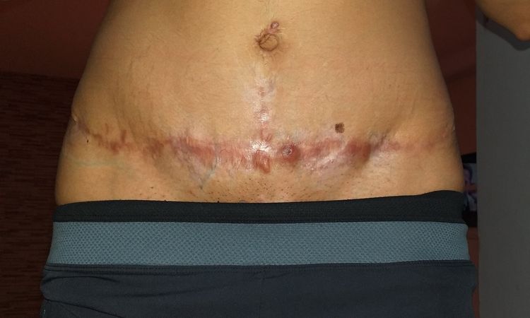 Abdominoplastia mal realizada - 7764