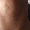 hilos tensores en cuello