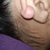 Extracción de queloide en oreja - 12125