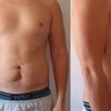 abdominoplastia, liposuccion o ejercicio