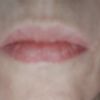 Ácido hialurónico+ micropigmentación en labios sin márgenes definidos - 12337