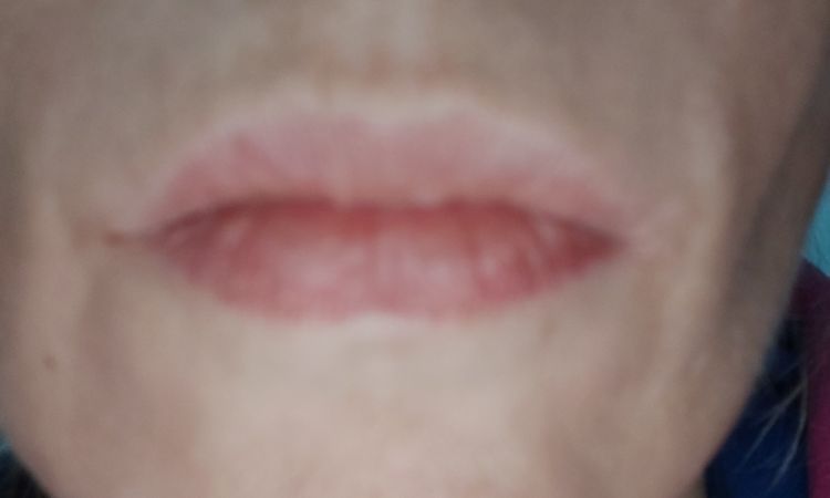 Ácido hialurónico+ micropigmentación en labios sin márgenes definidos - 12337