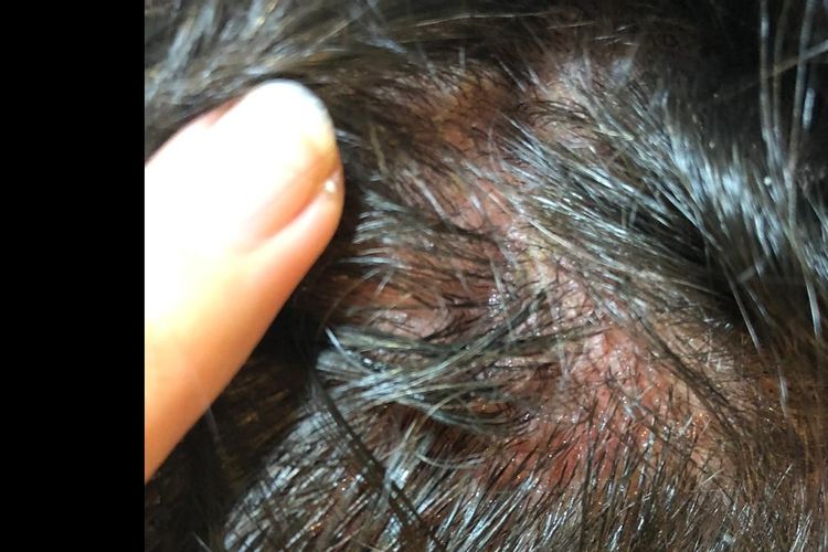Dermatitis seborreica NO para