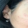 Cicatriz de acne con acido hialuronico - 12370