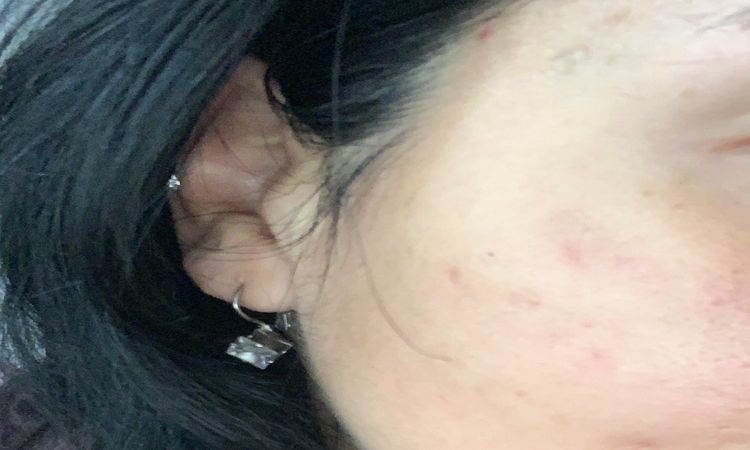 Cicatriz de acne con acido hialuronico - 12370