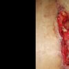 Rechazo de puntos abdominoplastia