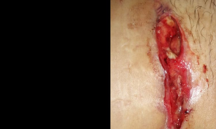 Rechazo de  puntos abdominoplastia - 15600