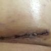 Cicatriz en aumento mamario