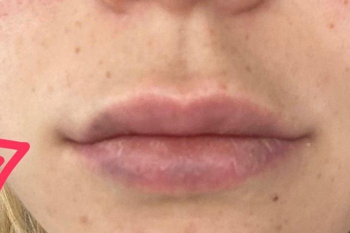 ¿Es normal que los labios queden así después de aplicar ácido ...