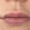 ¿Es normal que los labios queden así después de aplicar ácido hialuronico?