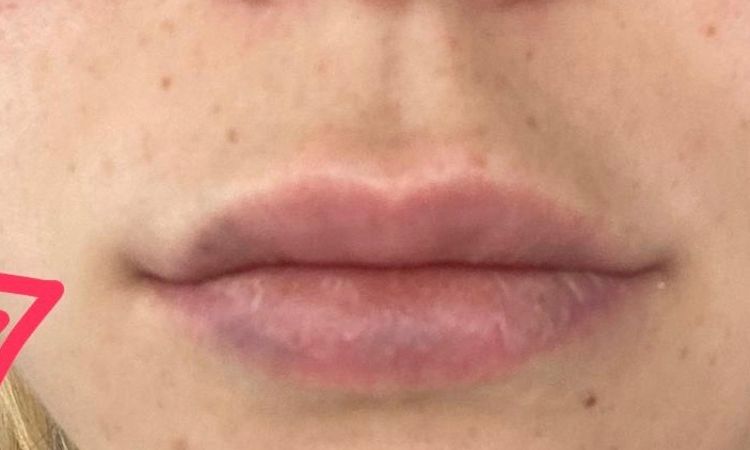 ¿Es normal que los labios queden así después de aplicar ácido hialuronico? - 15752