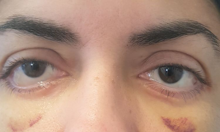 Blefaroplastia inferior + cantopexia - 15756