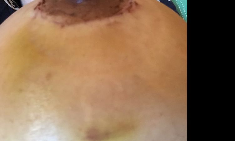 Implantes con moretones - 15877