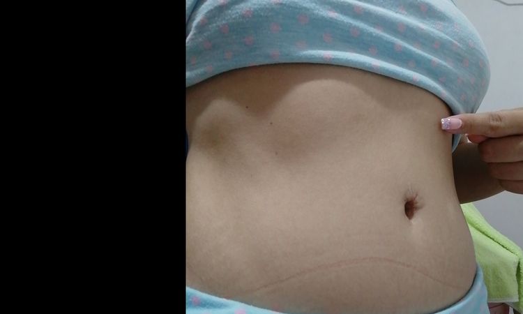 Abultamiento en la parte alta del abdomen después de lipoabdominoplastia. - 15881