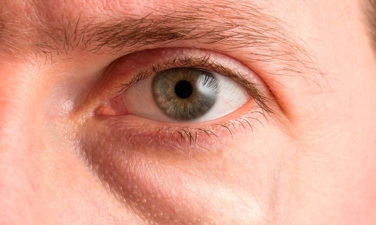 ¿Mejor tratamiento para drenar edema ojos en párpados inferiores? - 16089