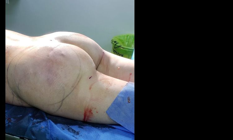¿Se puede hacer retoque en gluteos? - 16114