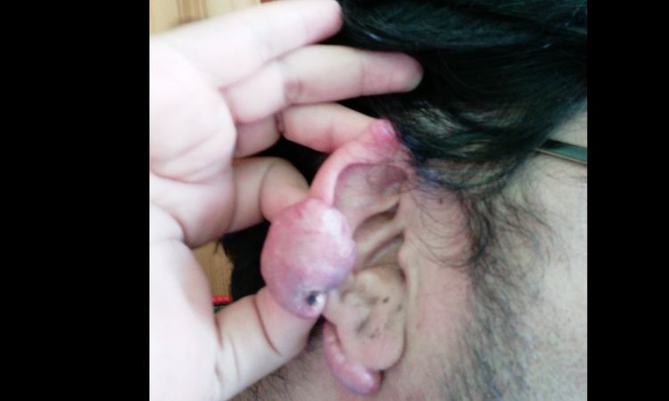 Queloide radioterapia - 16220