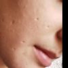 Marcas de varicela en la cara - 16340