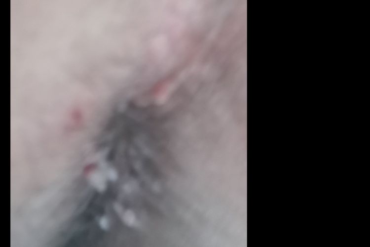 Me aparecieron una especie de verrugas en el ano y quisiera eliminarlas