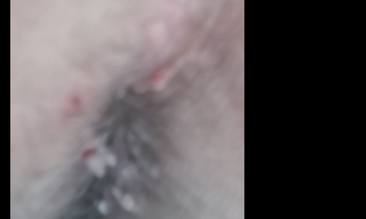 Me aparecieron una especie de verrugas en el ano y quisiera eliminarlas - 16517