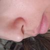 Rinomodelacion con hilo en la nariz - 16702