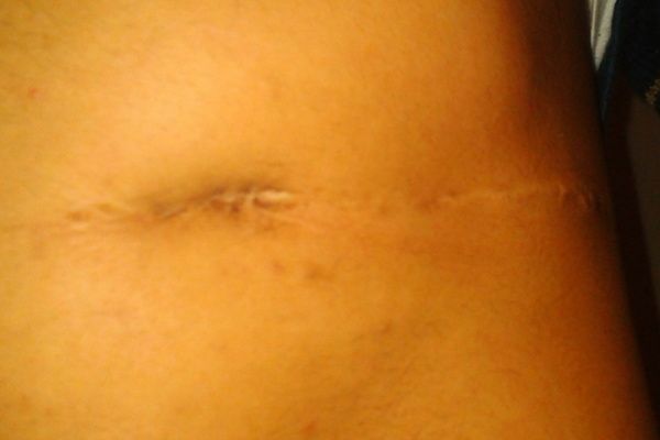 Cicatriz de hernia Diafragmatica - 37