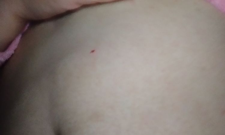 Como sacar o tratar un seroma tras 1 año de operada - 43638