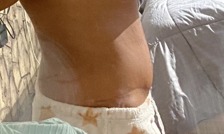 Abdomen abultado tras 5 meses de abdominoplastia - 43823