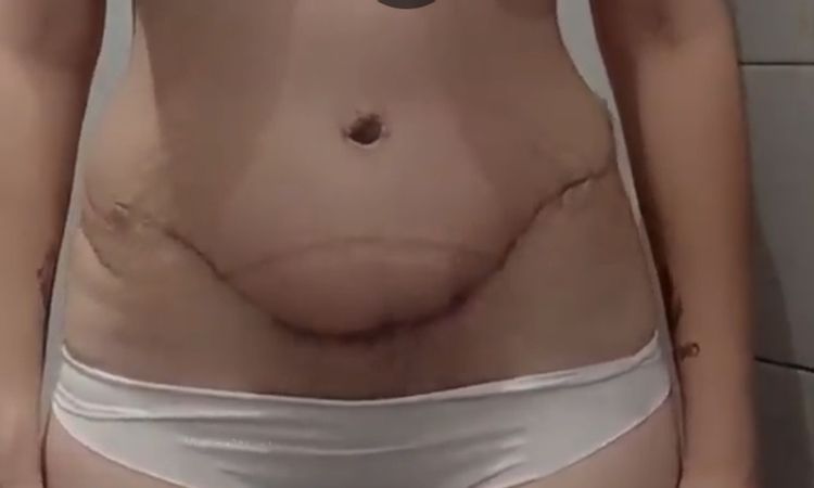 Abdomen abultado 3 meses abdominoplastia - 43834