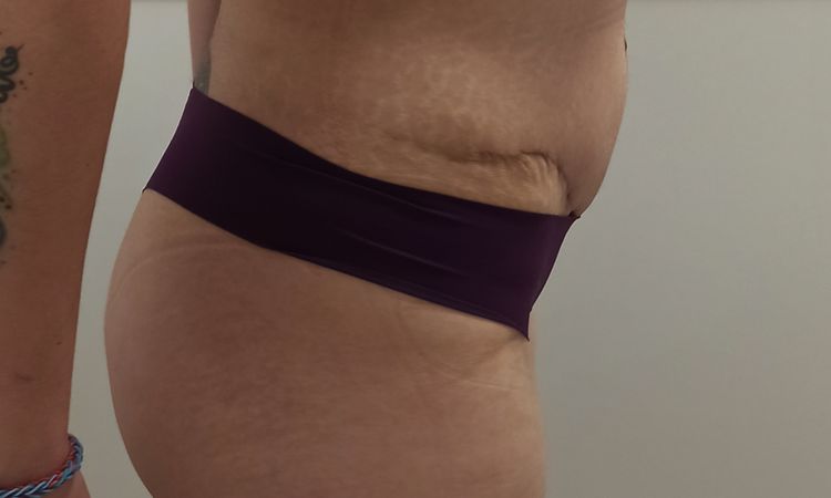 Abdomen abultado 3 meses abdominoplastia - 43835