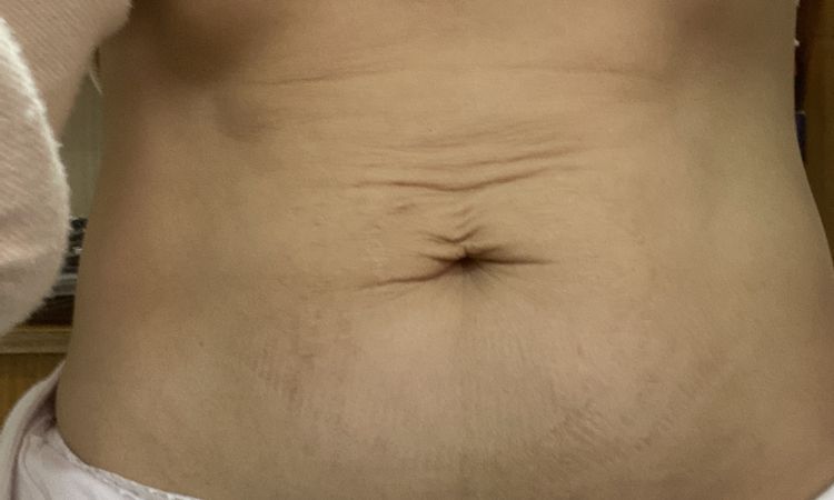 Eliminar flacidez abdominal, piel arrugada en la zona del ombligo - 44012