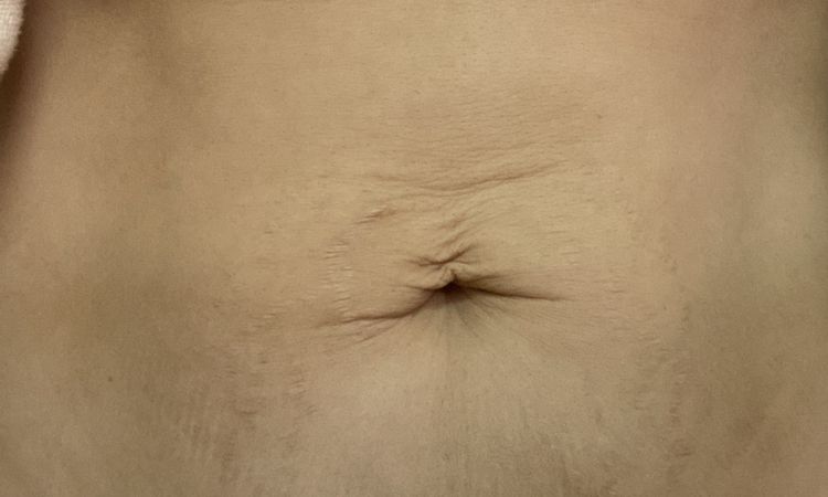 Eliminar flacidez abdominal, piel arrugada en la zona del ombligo - 44014