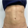 Cómo eliminar fibrosis tras 3 años de marcación abdominal