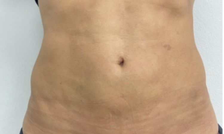 Cómo eliminar fibrosis tras 3 años de marcación abdominal - 44090