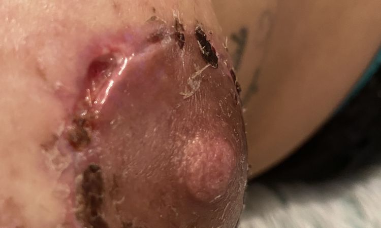Pexia mamaria se abre al retirar los puntos - 44154