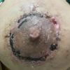 Pexia mamaria se abre al retirar los puntos
